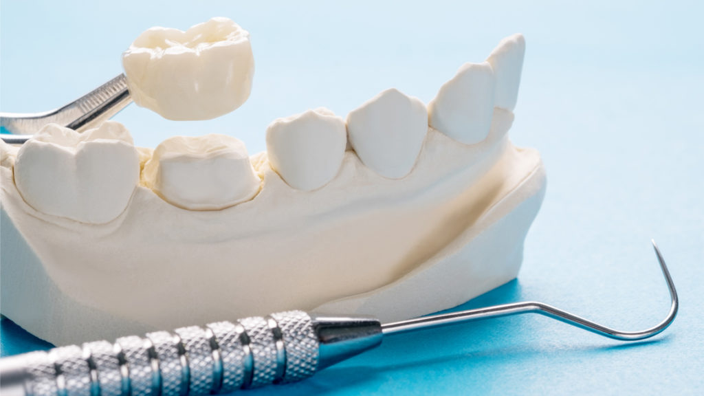 Closeup/Prosthodontics or Prosthetic/Single tooth crown and bridge equipment model express fix restoration.