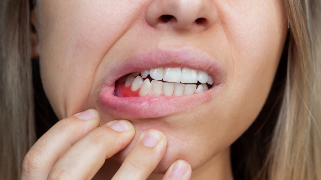 Young woman showing her gum disease symptoms, including red, inflamed gums.