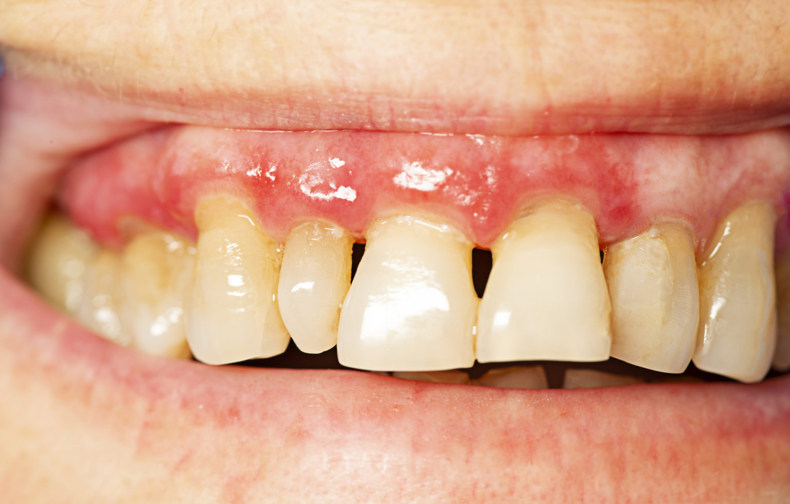 Upclose photo of patient with gum disease.