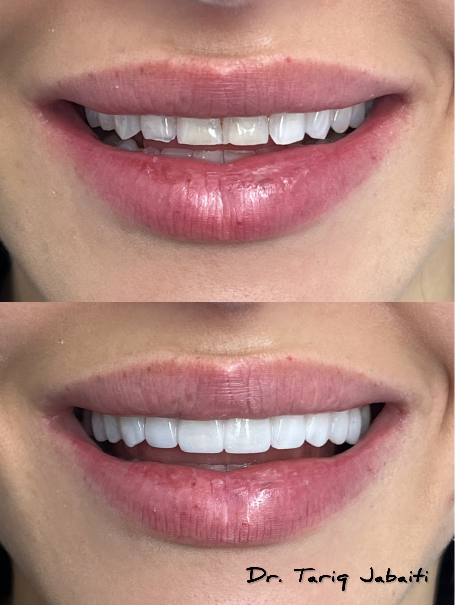 before and after prepless veneers by Dr. Jabaiti