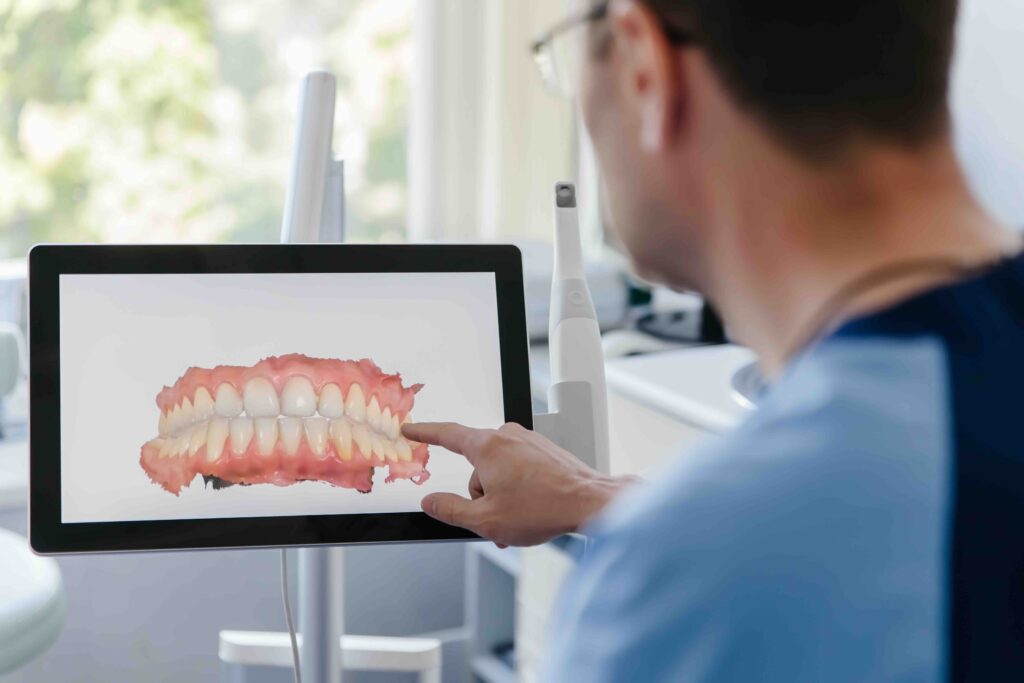 Intra-Oral Scanner