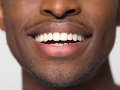natural smile veneers