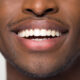 natural smile veneers